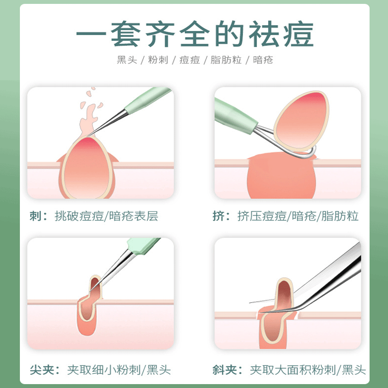 Stainless steel blackhead remover kit - 5 piece set for pimple, blackhead, whitehead, and cyst extraction - ready to ship